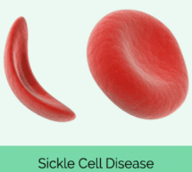 NATIONAL SICKLE CELL DISEASE POLL OF AFRICAN AMERICANS DISPELS LONG HELD VIEWS